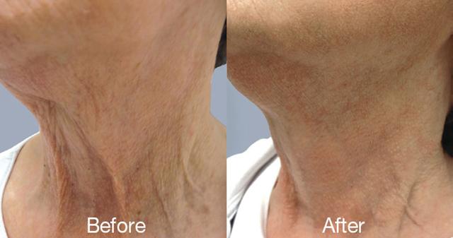 Microneedling result at Epi Center MedSpa in San Francisco, CA
