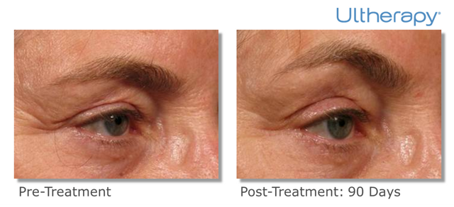 Microneedling result at Epi Center MedSpa in San Francisco, CA