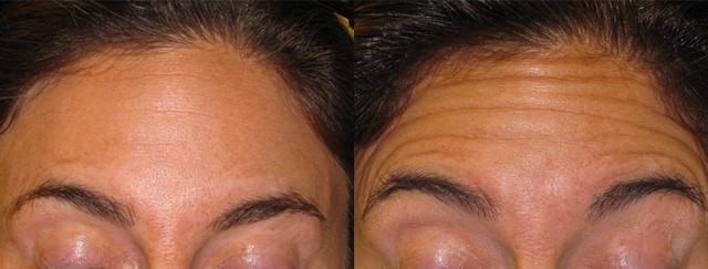 Botox result at Epi Center MedSpa in San Francisco, CA