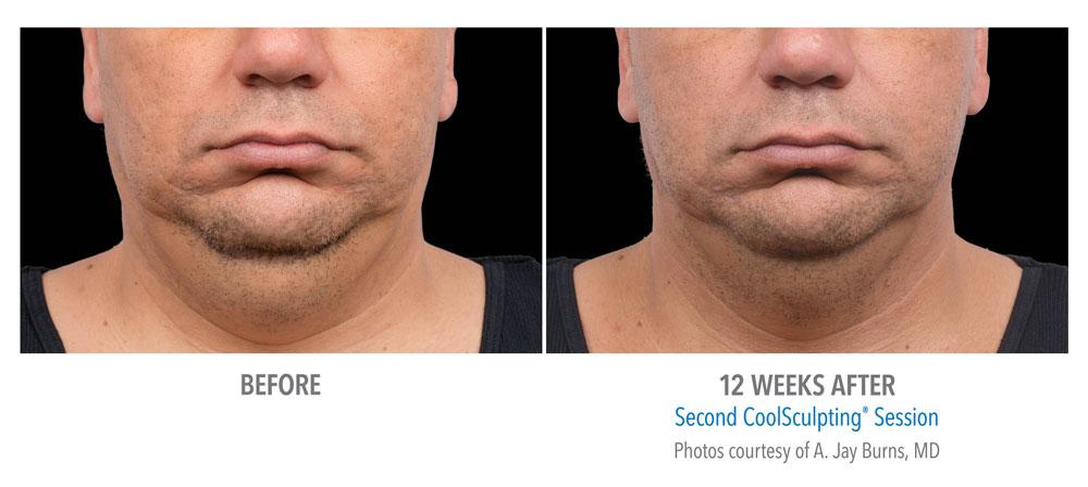 Epi Center MedSpa coolsculpting result — San Francisco, CA