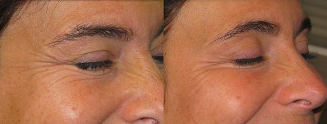 Botox result at Epi Center MedSpa in San Francisco, CA