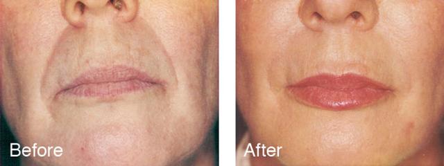 Microneedling result at Epi Center MedSpa in San Francisco, CA