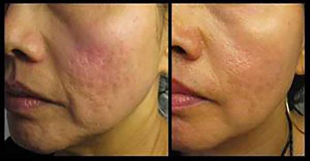 Microneedling result at Epi Center MedSpa in San Francisco, CA