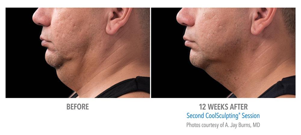 Epi Center MedSpa coolsculpting result — San Francisco, CA