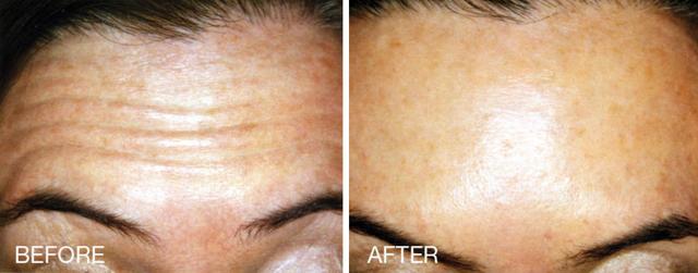 Botox result at Epi Center MedSpa in San Francisco, CA