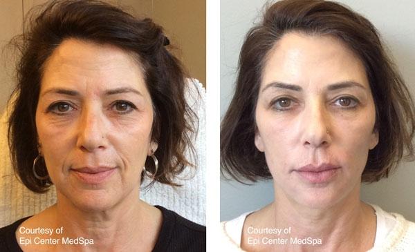 Microneedling result at Epi Center MedSpa in San Francisco, CA