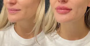 BOYD lip filler result — Detroit, MI