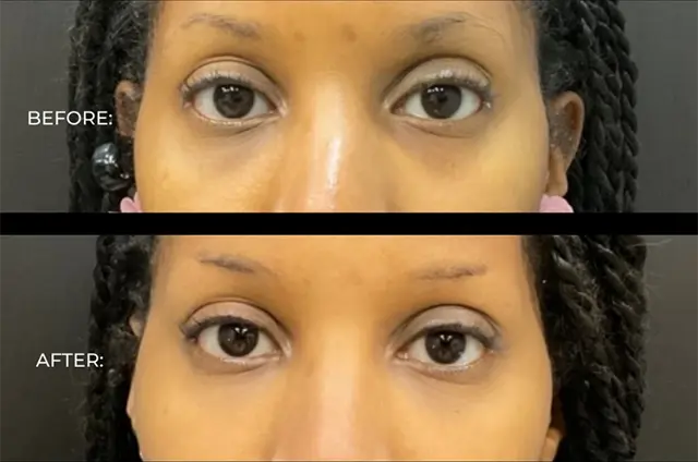 Dermal Fillers result at BOYD in Detroit, MI