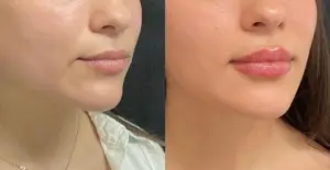 BOYD lip filler result — Detroit, MI