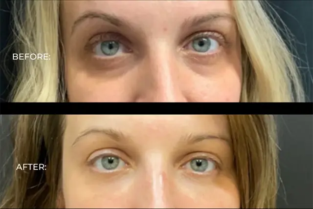 Dermal Fillers result at BOYD in Detroit, MI