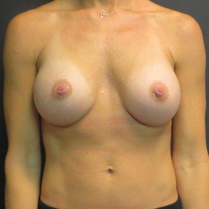 Breast Augmentation result at Quinn Plastic Surgery & Aesthetic Center: Dr. John Michael Quinn in Leawood, KS