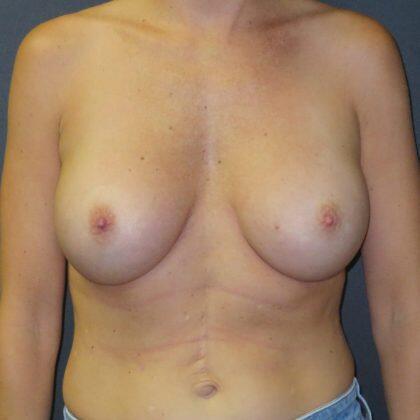Breast Augmentation result at Quinn Plastic Surgery & Aesthetic Center: Dr. John Michael Quinn in Leawood, KS