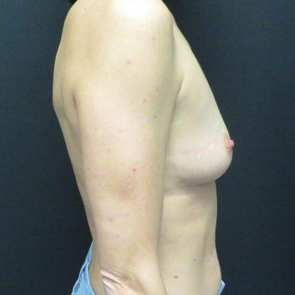 Breast Augmentation result at Quinn Plastic Surgery & Aesthetic Center: Dr. John Michael Quinn in Leawood, KS