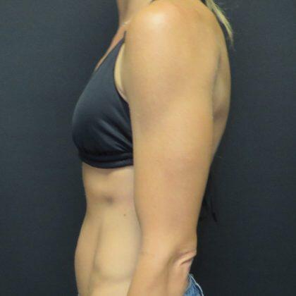 Quinn Plastic Surgery & Aesthetic Center: Dr. John Michael Quinn breast augmentation result — Leawood, KS