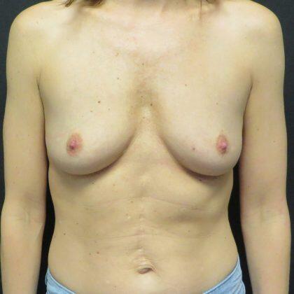 Breast Augmentation result at Quinn Plastic Surgery & Aesthetic Center: Dr. John Michael Quinn in Leawood, KS