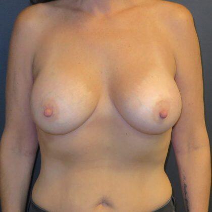 Breast Augmentation result at Quinn Plastic Surgery & Aesthetic Center: Dr. John Michael Quinn in Leawood, KS