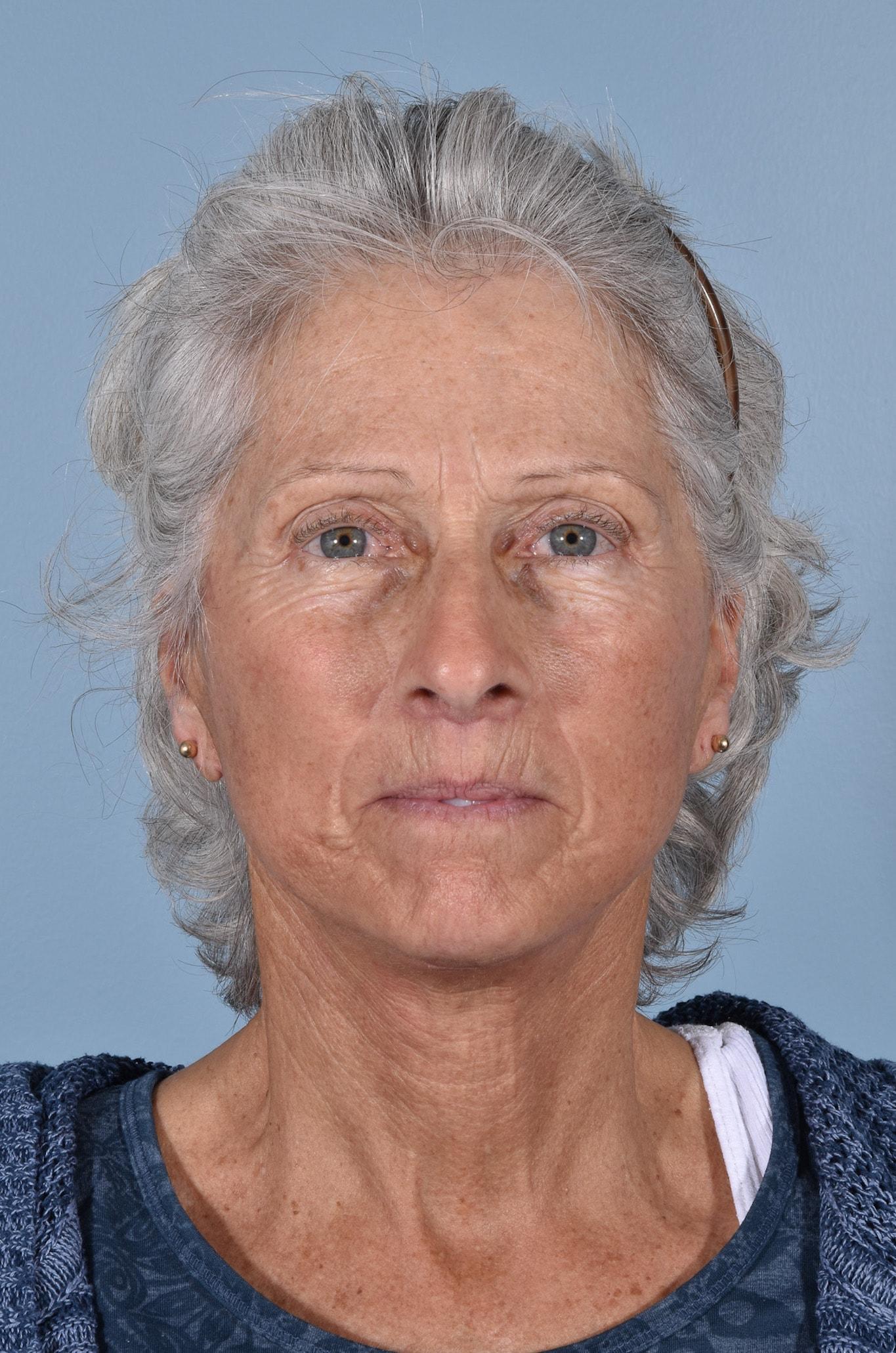 Capital Facial Plastic Surgery (Adam Singleton, MD) facelift after — Chevy Chase, MD