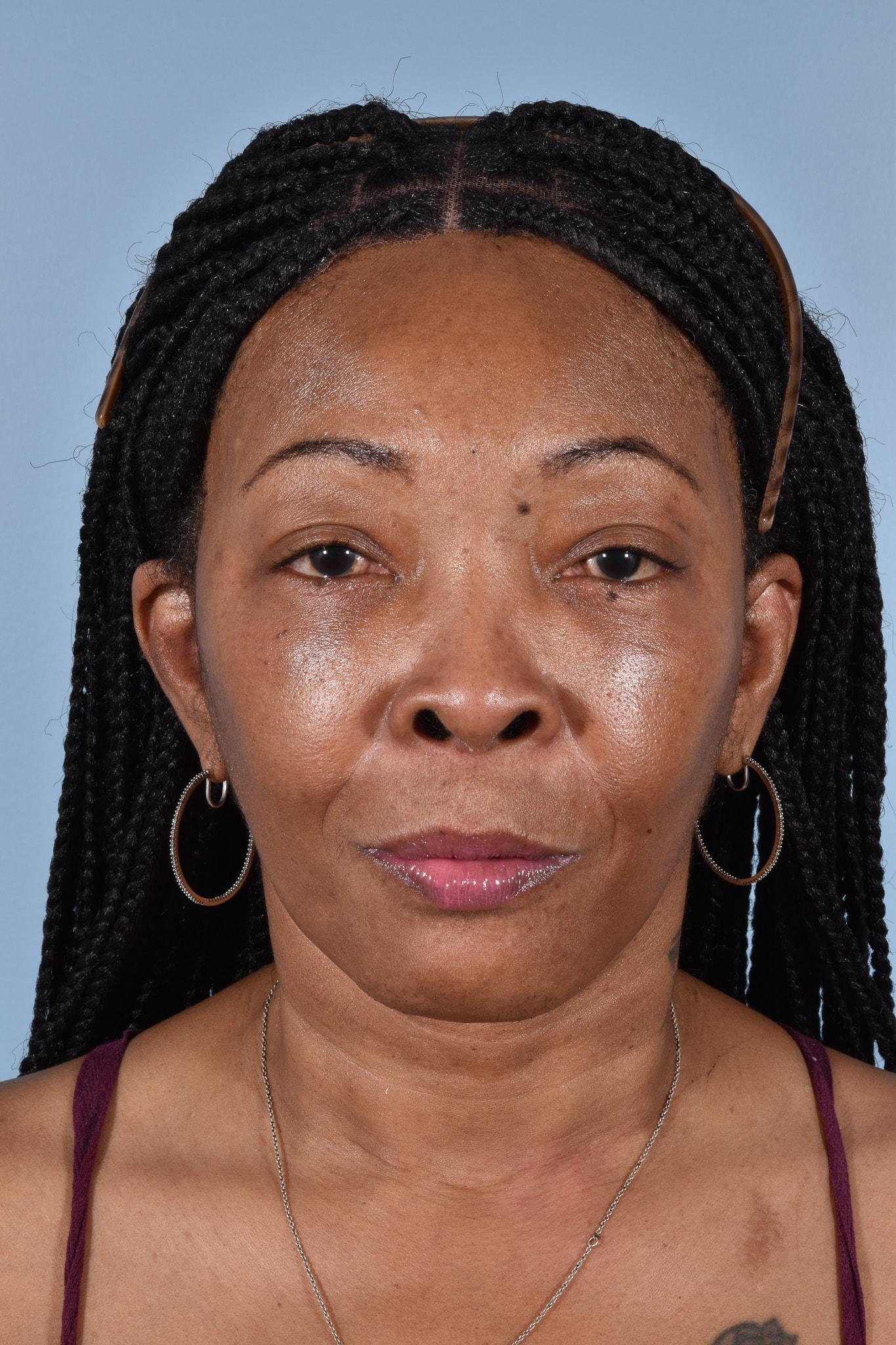 Capital Facial Plastic Surgery (Adam Singleton, MD) facelift after — Chevy Chase, MD