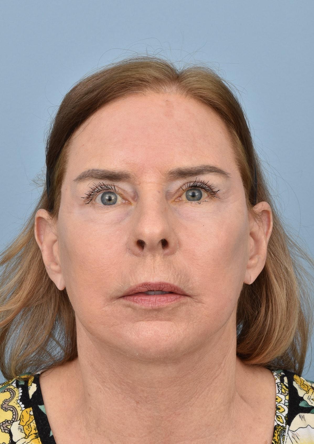 Capital Facial Plastic Surgery (Adam Singleton, MD) facelift after — Chevy Chase, MD
