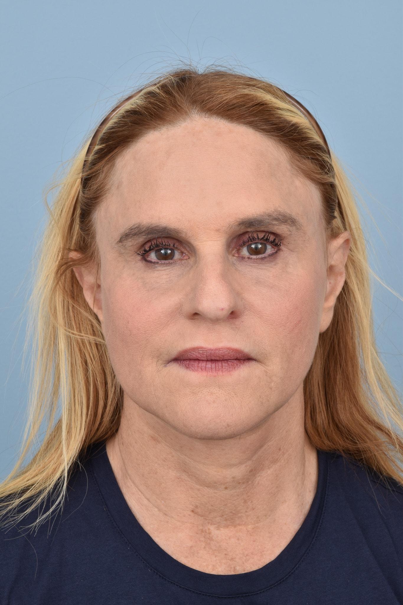 Capital Facial Plastic Surgery (Adam Singleton, MD) facelift after — Chevy Chase, MD