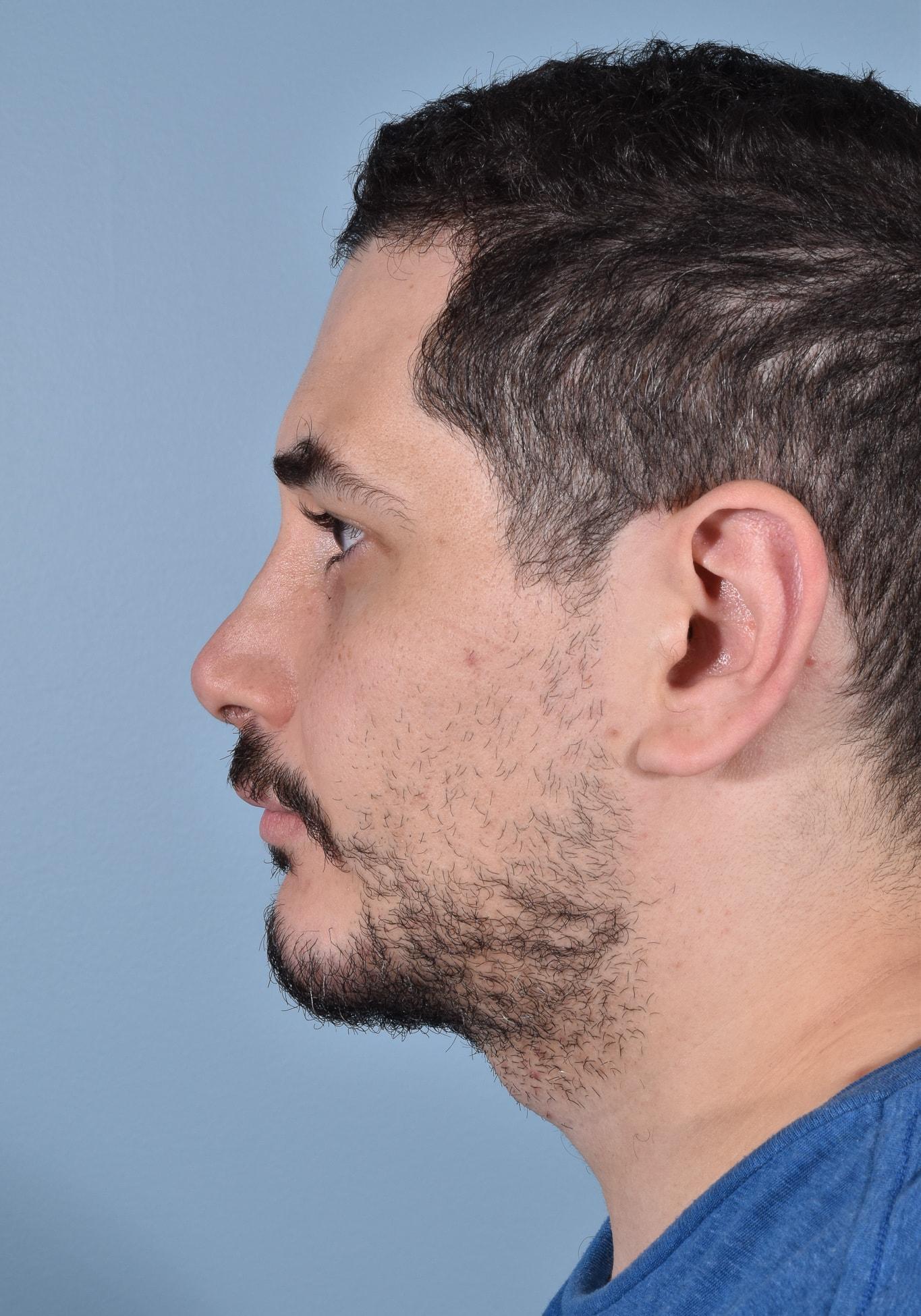 Capital Facial Plastic Surgery (Adam Singleton, MD) chin implant after — Chevy Chase, MD