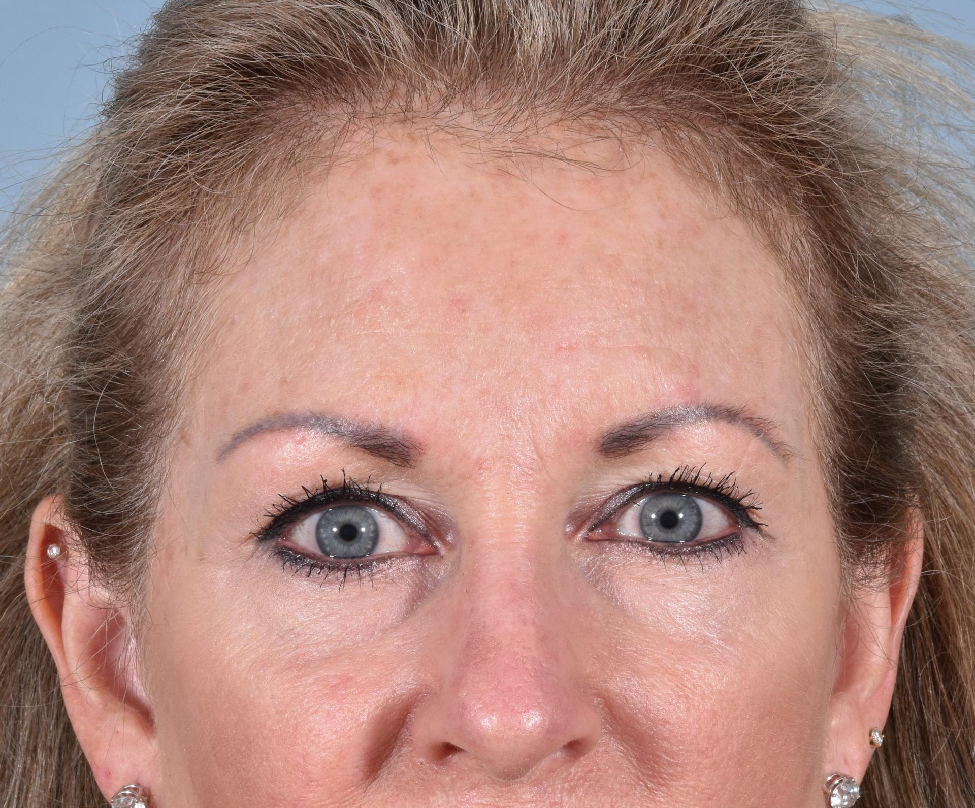 Capital Facial Plastic Surgery (Adam Singleton, MD) morpheus8 after — Chevy Chase, MD