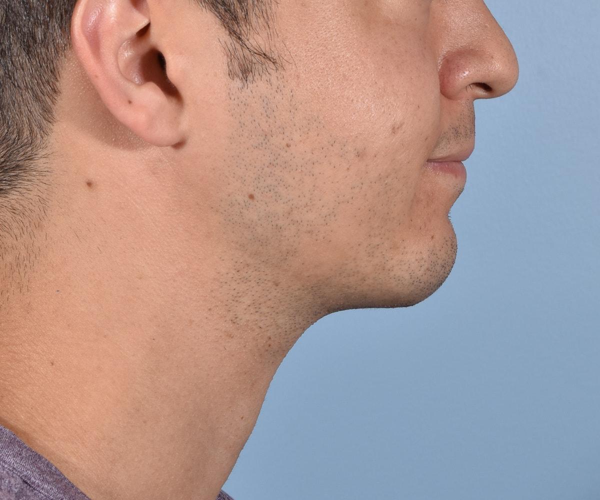 Capital Facial Plastic Surgery (Adam Singleton, MD) chin implant after — Chevy Chase, MD
