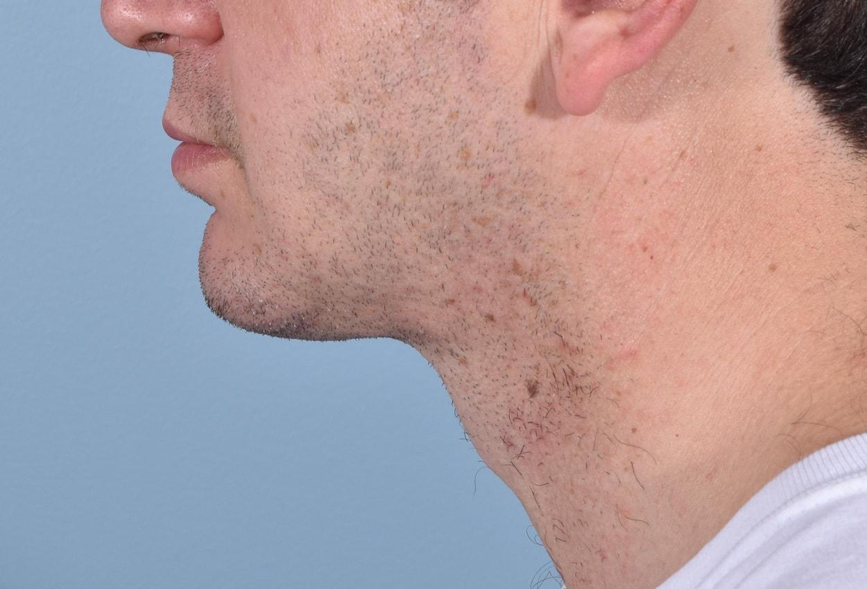 Capital Facial Plastic Surgery (Adam Singleton, MD) chin implant after — Chevy Chase, MD