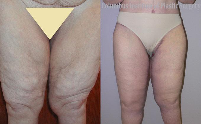 Columbus Institute thigh lift after — Columbus, OH