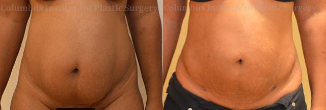 Liposuction result at Columbus Institute in Columbus, OH