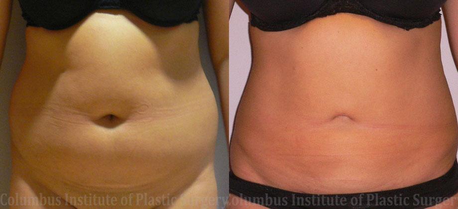 Columbus Institute breast reduction result — Columbus, OH