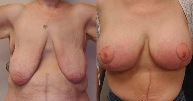 Breast Augmentation result at Columbus Institute in Columbus, OH