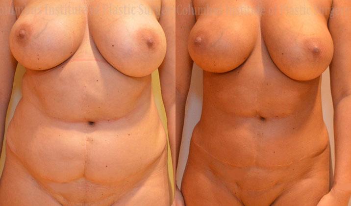 Columbus Institute breast reduction result — Columbus, OH