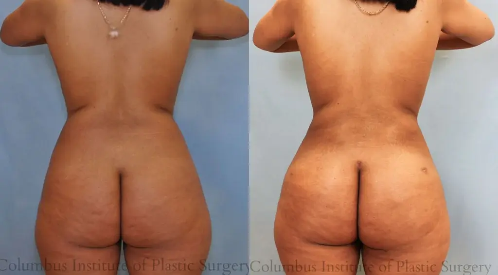 Columbus Institute breast reduction result — Columbus, OH