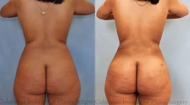 Breast Reduction result at Columbus Institute in Columbus, OH