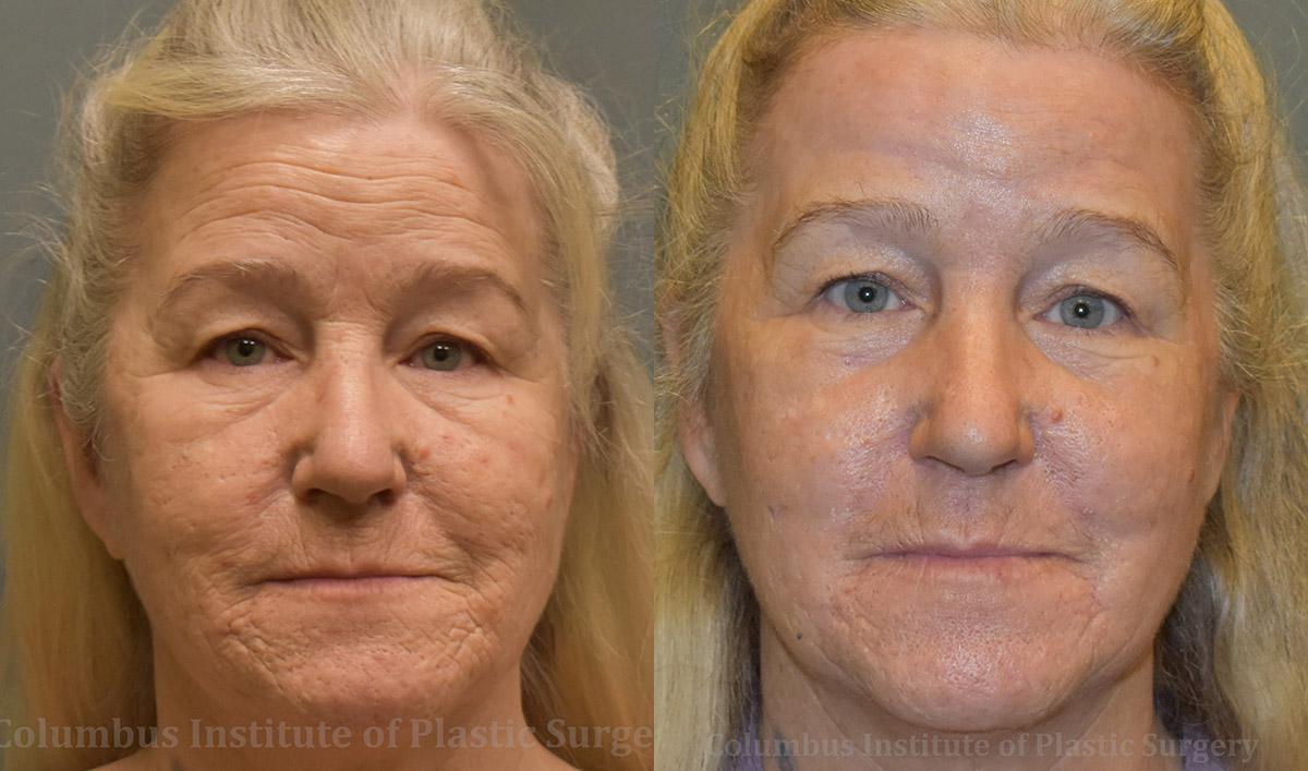 Columbus Institute chemical peel result — Columbus, OH