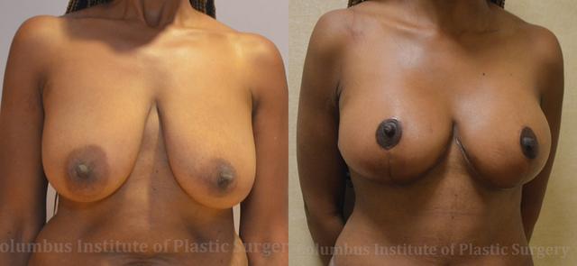 Breast Lift result at Columbus Institute in Columbus, OH