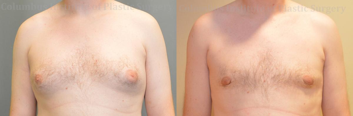 Columbus Institute gynecomastia result — Columbus, OH