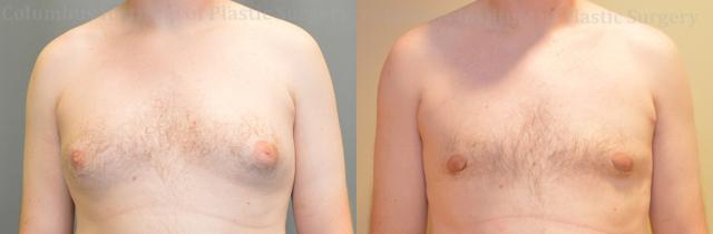 Gynecomastia Surgery result at Columbus Institute in Columbus, OH