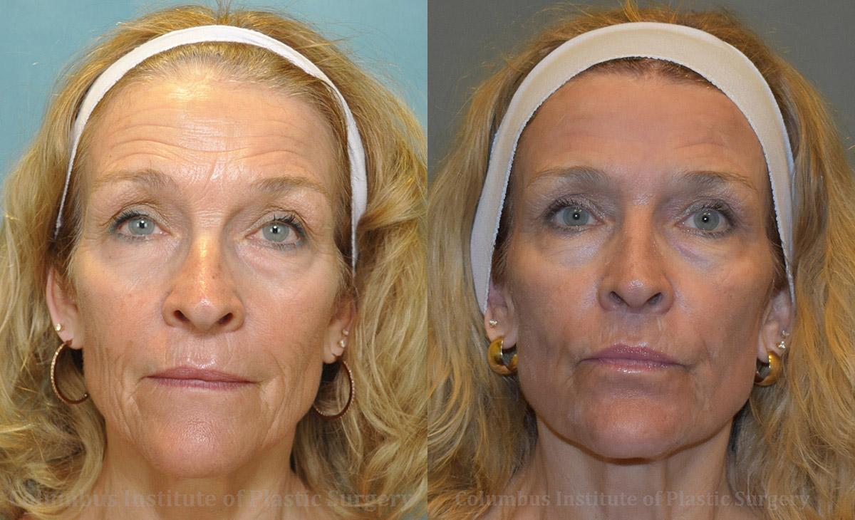 Columbus Institute chemical peel result — Columbus, OH