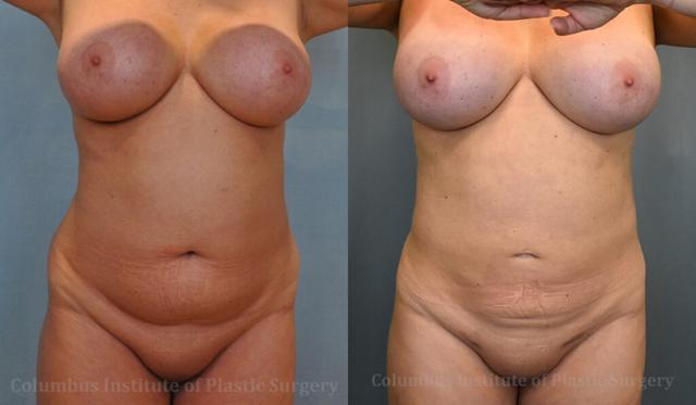 Breast Reduction result at Columbus Institute in Columbus, OH