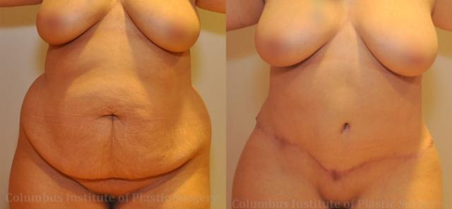 Liposuction result at Columbus Institute in Columbus, OH