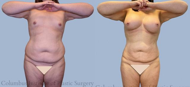 Breast Reduction result at Columbus Institute in Columbus, OH
