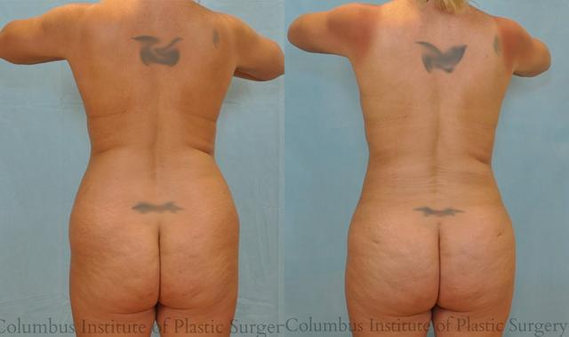 Liposuction result at Columbus Institute in Columbus, OH