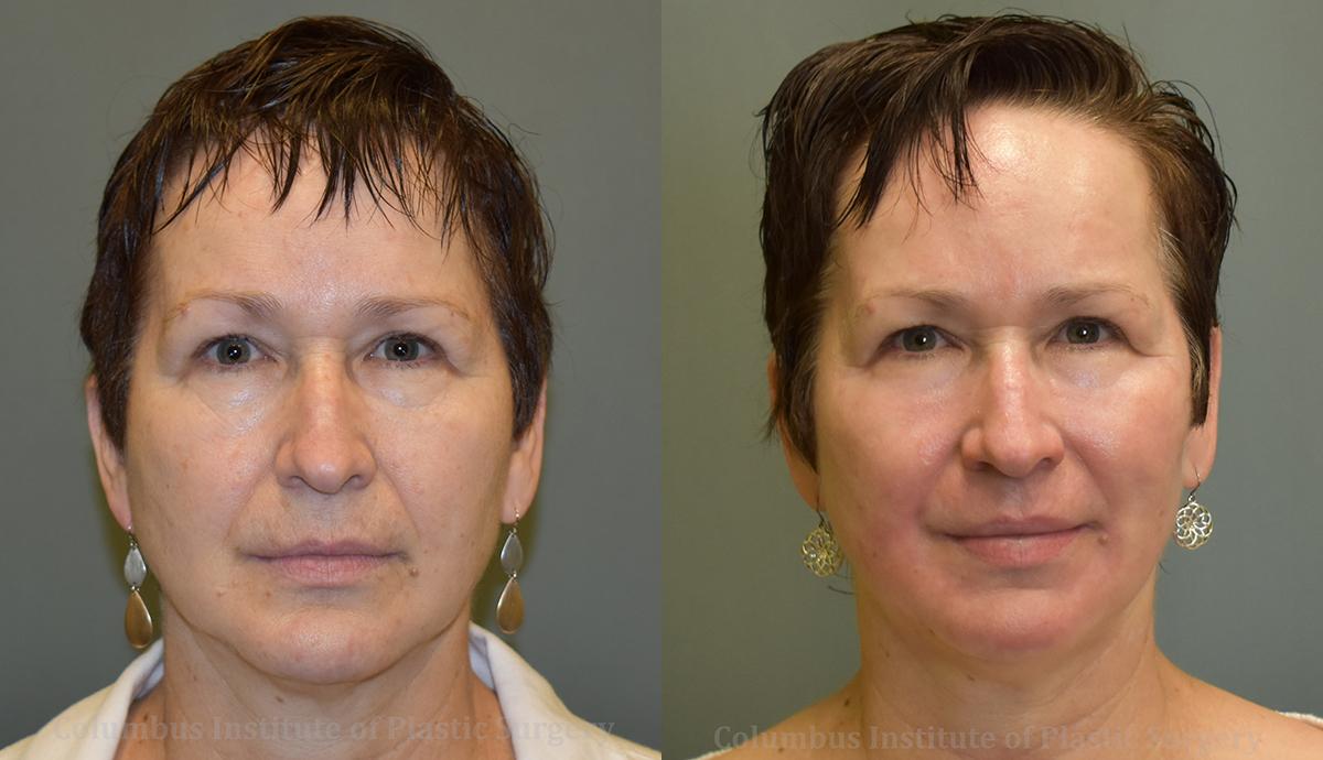 Columbus Institute chemical peel result — Columbus, OH