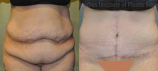 Tummy Tuck result at Columbus Institute in Columbus, OH