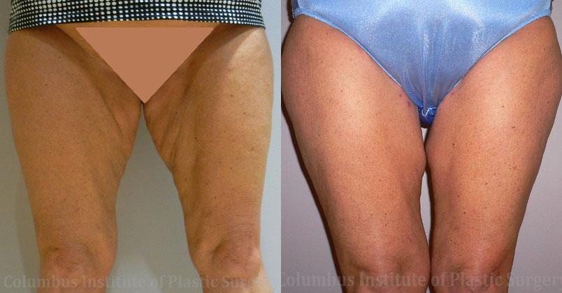 Columbus Institute thigh lift after — Columbus, OH