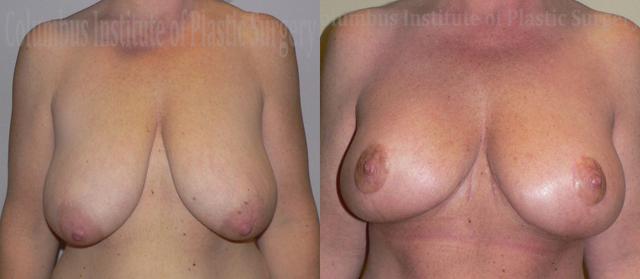 Breast Lift result at Columbus Institute in Columbus, OH