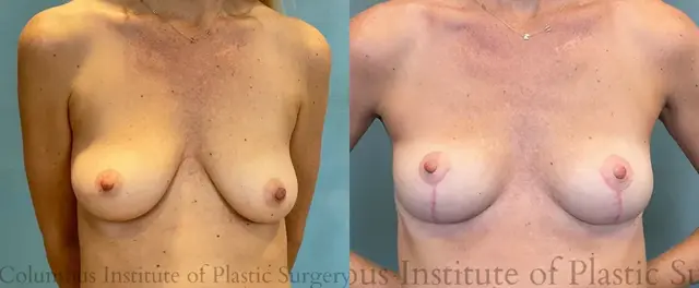 Breast Lift result at Columbus Institute in Columbus, OH