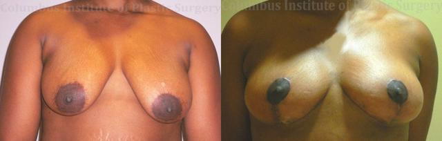 Breast Lift result at Columbus Institute in Columbus, OH